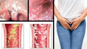 Урологическое заболевание молочница википедия