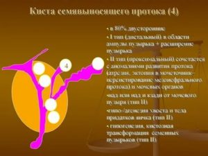 Что такое киста семявыносящего протока