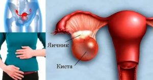 Как узнать есть киста яичника или нет