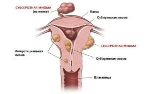 Антицеллюлитный крем при миоме матки