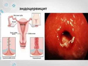 Лечение эндоцервицита при климаксе