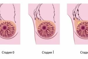 Малигнизация опухоли молочной железы