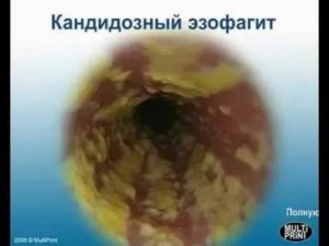 Кандидоз пищевода при спиде