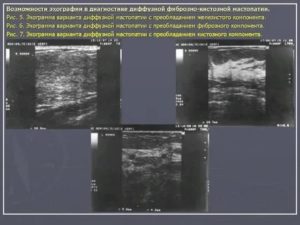 Узи молочных желез признаки диффузной мастопатии