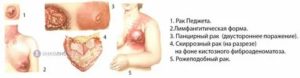 Рак педжета молочной железы симптомы и признаки