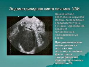 Почему возникает эндометриоидная киста яичника