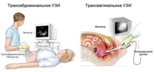 Чем вагинальное узи отличается от трансабдоминального