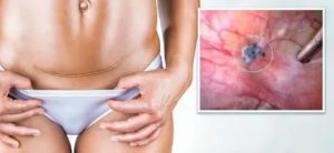 Как лечить эндометриоз матки в домашних условиях после кесарева сечения