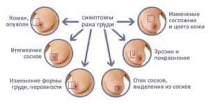 Признаки рака соска молочной железы