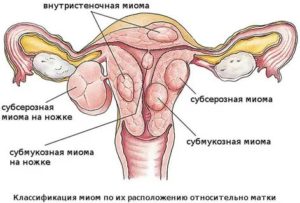 Можно ли загорать при миоме матки и кисте