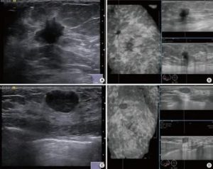 Трехмерное узи молочной железы