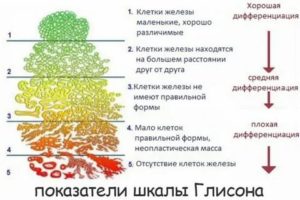 Что такое мелкоацинарная аденокарцинома предстательной железы баллов по глисону