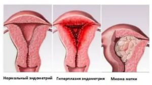 Миома матки и гиперплазия эндометрия при климаксе