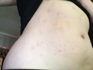 Может быть сыпь перед месячными по всему телу
