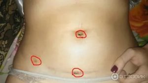 Можно ли спать на животе после лапароскопии кисты яичника