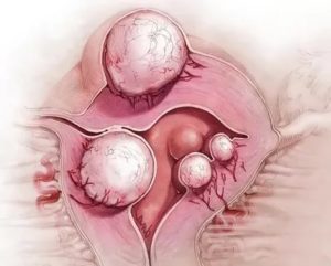 Можно ли при эндометриозе и миоме посещать баню