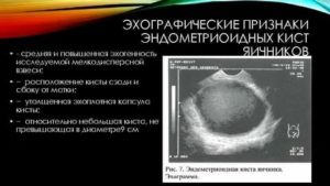 Что такое эхографические признаки кисты желтого тела