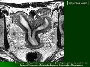 Мрт матки двурогая матка