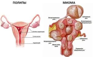 Эндометриоз аденомиоз миому полипы эндометрия