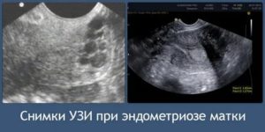 Можно ли распознать эндометриоз по узи