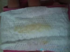 Выделения из влагалища при приеме дюфастона