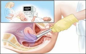 Как делают узи половых органов у женщины