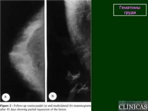 Гематома молочной железы лечение препараты