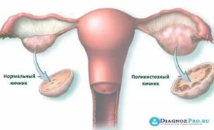 Когда начинаются месячные после лапароскопии поликистоза яичников