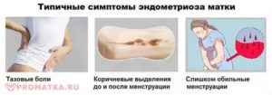 Эндометриоз симптомы и лечение у подростков