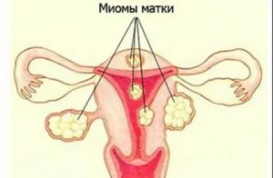 Могут ли быть скудные месячные при нормальном эндометрии