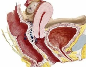 Иссечение ретроцервикального эндометриоза что это такое