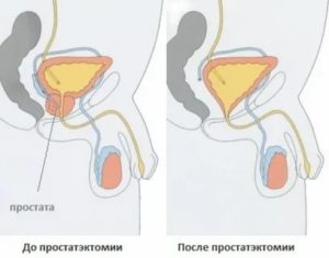 Что будет если полностью удалить простату