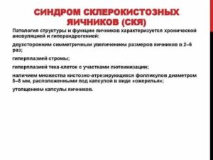 Что такое склерокистозное изменения яичников