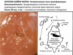 Цитологическая картина эктопии шейки матки что это такое