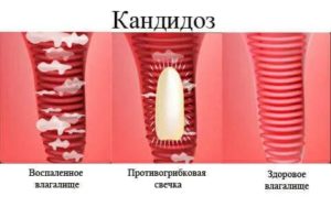 Молочница и задержка из за чего такое может быть