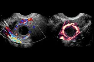 Когда узи показывает кисту желтого тела