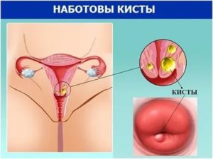 Что такое кистозное изменение шейки матки что это такое