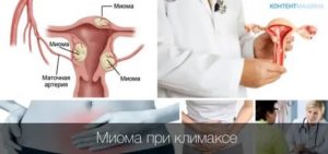 Может ли миома уменьшится в размерах при климаксе