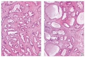 Доброкачественная гиперплазия предстательной железы микропрепарат