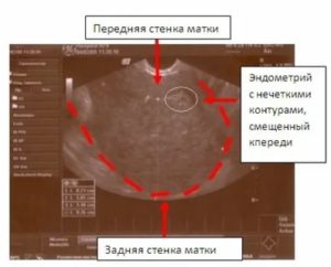 Передняя и задняя стенка матки на узи