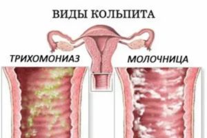 Как отличить молочницу от кольпита