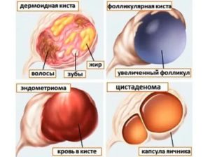 Какие бывают кисты яичника виды и симптомы