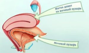 Может ли матка давить на мочевой пузырь при месячных